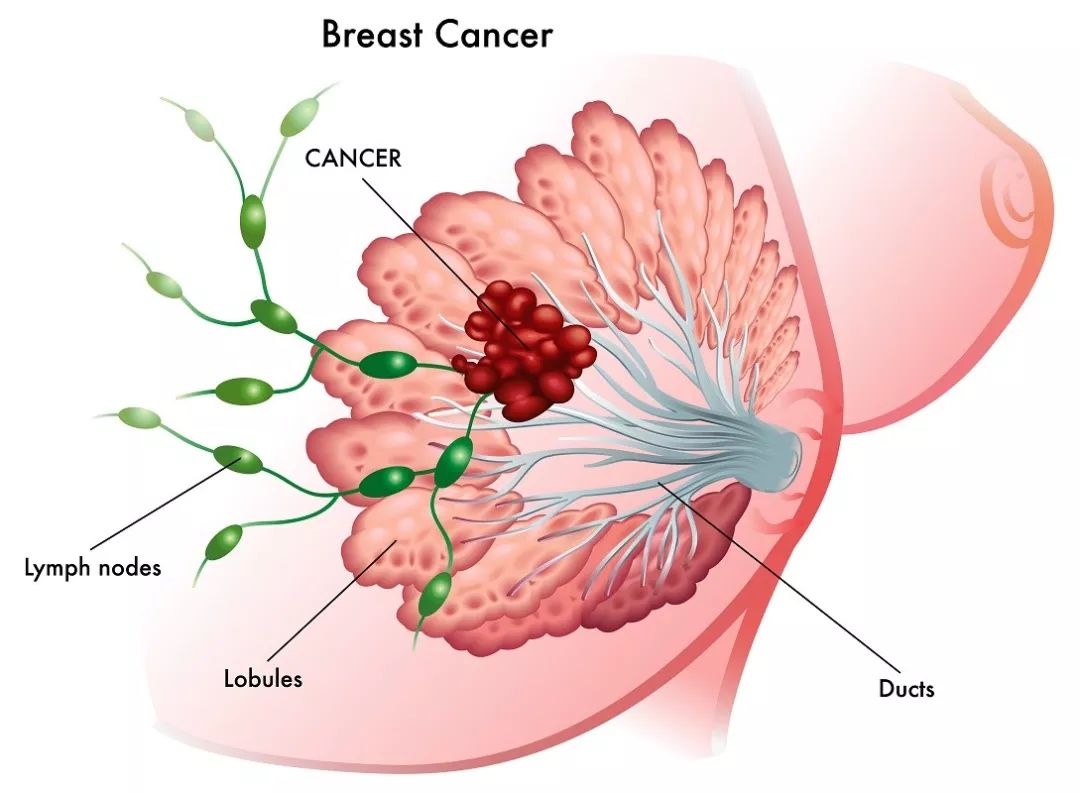 這四個方法都是乳腺癌的篩查方法