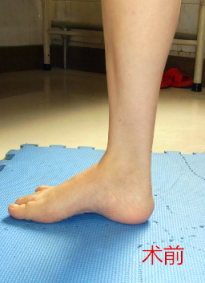 成人高弓足的诊断及治疗分析