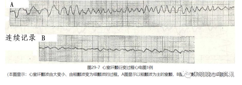 室颤晚期或由室颤粗颤波恶化而来,说明心肌状态极差,即使进行电击除颤