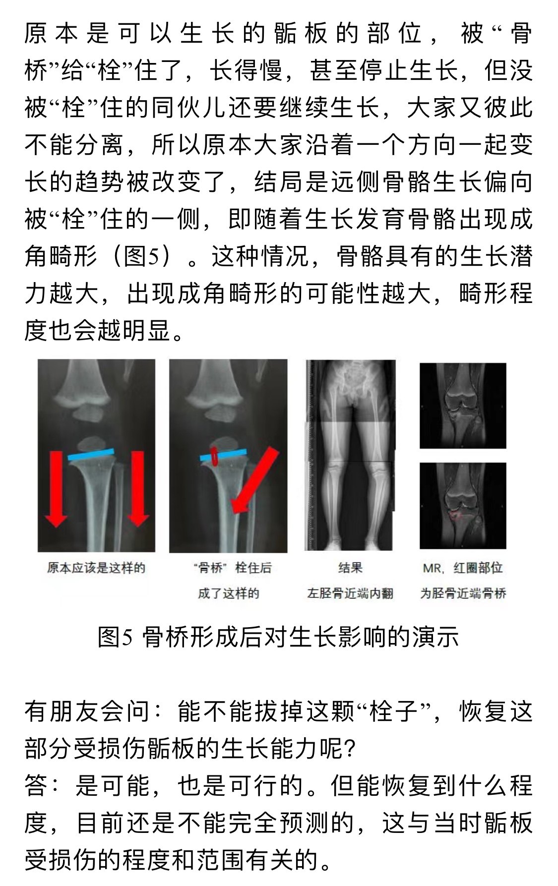 什么是"骺板骨桥(转载)