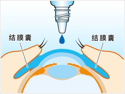 将药水滴入结膜上后,轻提上眼睑,以使药液充满整个结膜囊