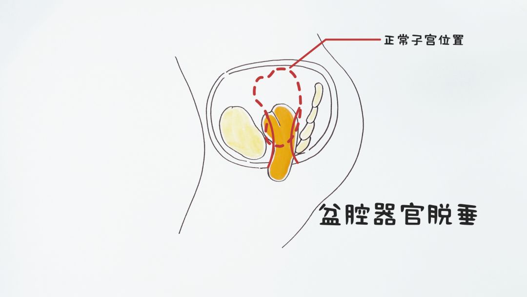 咳嗽一聲就漏尿你產後肯定沒做盆底肌