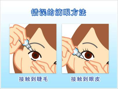 滴入结膜囊是滴哪里图片