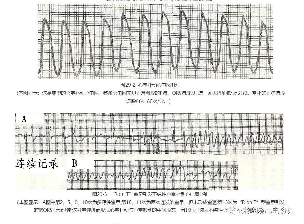 【临床实用心电图入门】 第二十九讲:心室扑动与颤动及濒死性心律失常