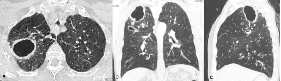 7种肺部常见空洞性疾病