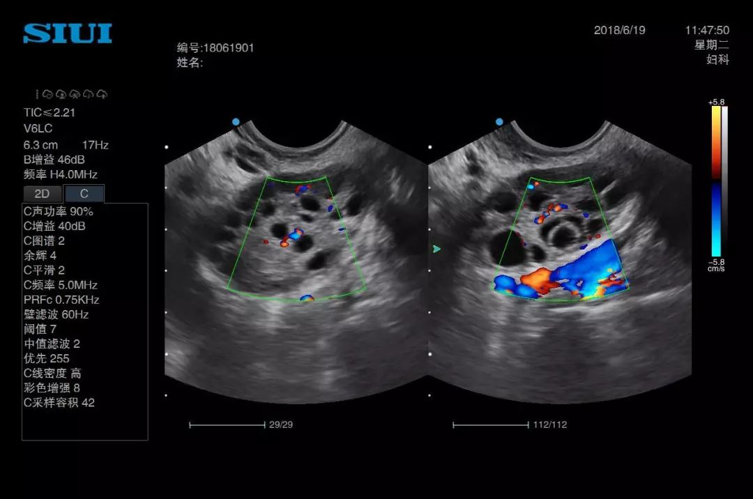 多囊卵巢阴超图片