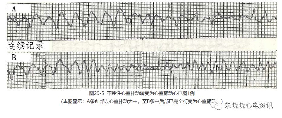 【临床实用心电图入门】 第二十九讲:心室扑动与颤动及濒死性心律失常