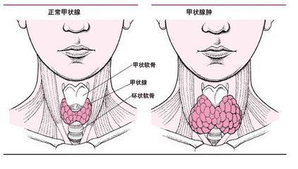 【醫學知識】邱晨自曝患癌 腫瘤醫生說了實話!_甲狀腺