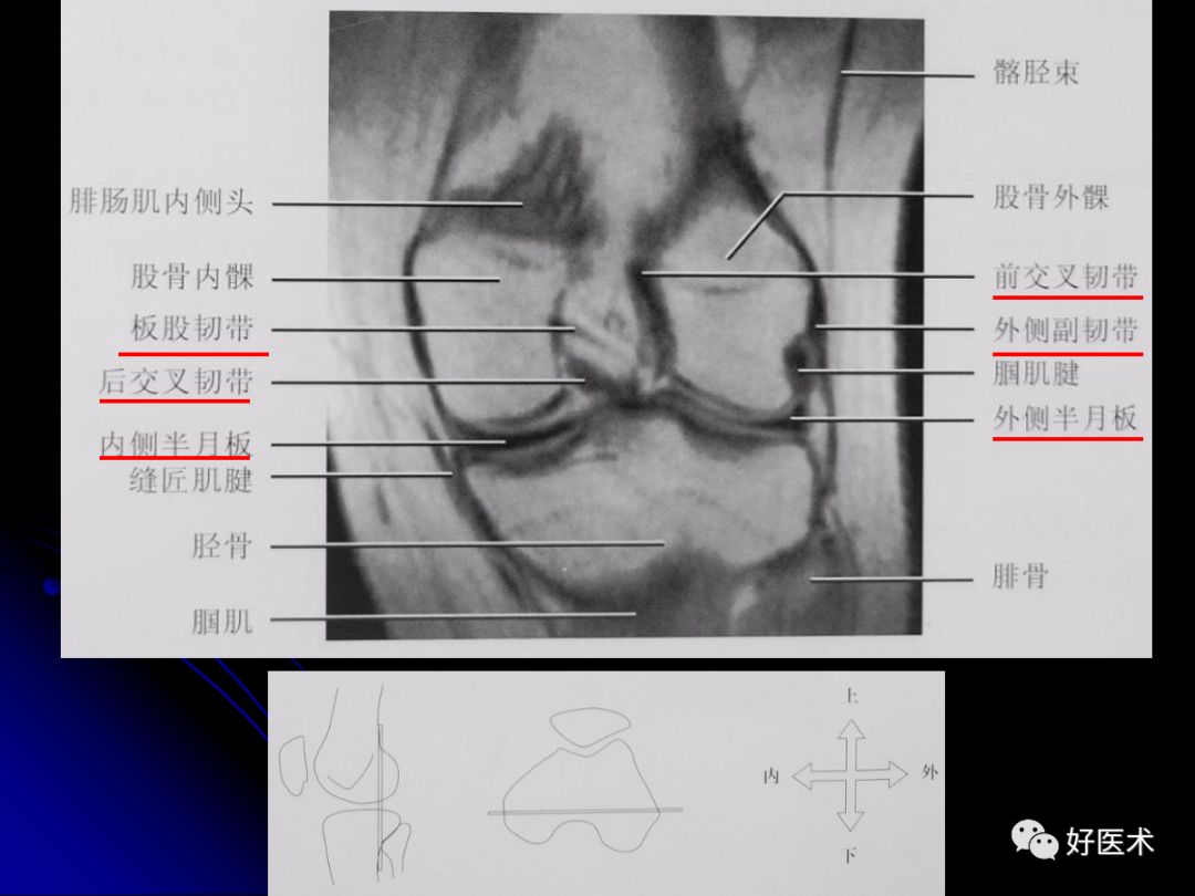 膝關節解剖及mri診斷技巧基礎必備