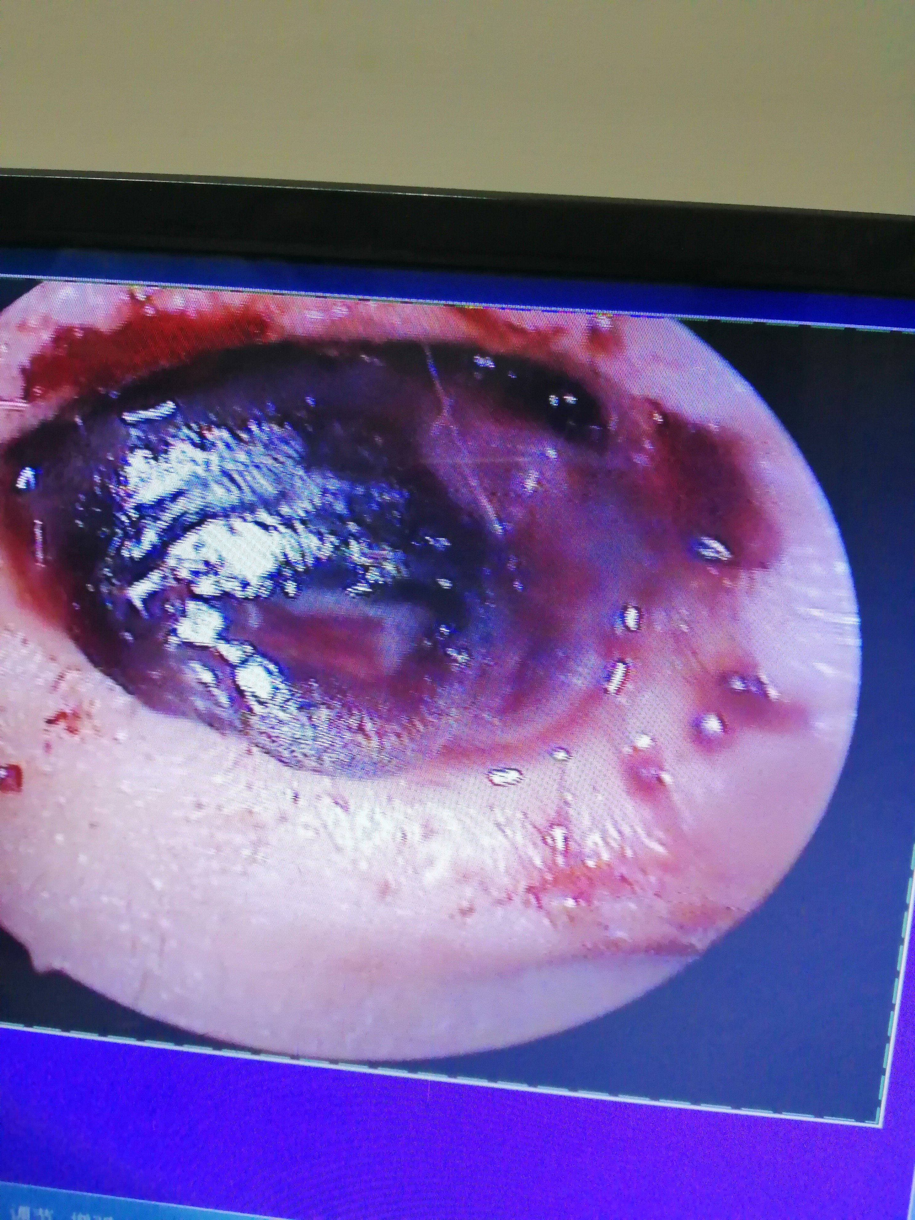 鼻窦骨瘤图片图片