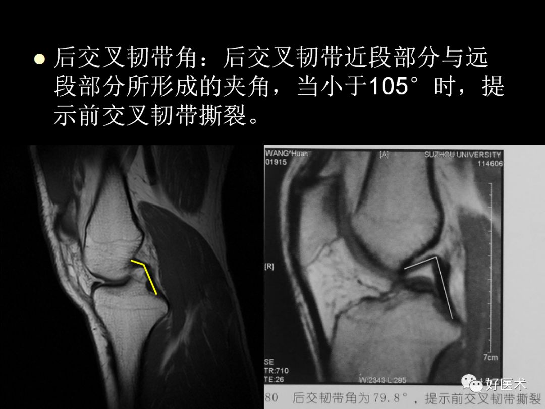 膝關節解剖及mri診斷技巧基礎必備