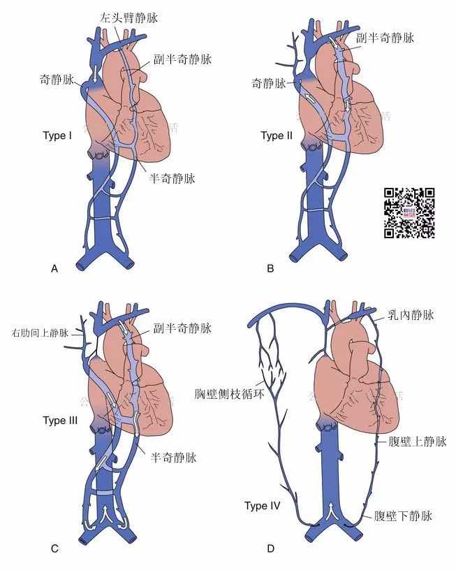 双下腔静脉图片