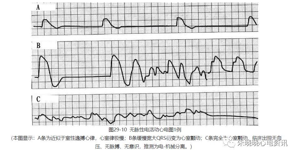 【临床实用心电图入门】 第二十九讲:心室扑动与颤动及濒死性心律失常