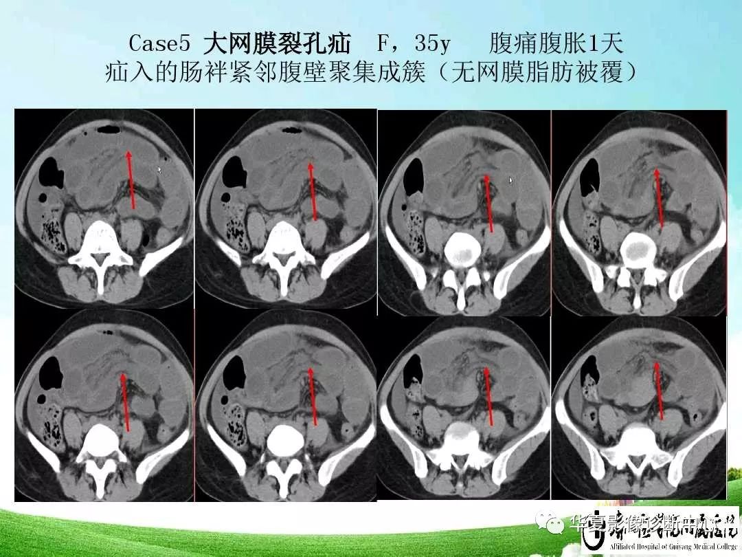 闭孔疝ct图片