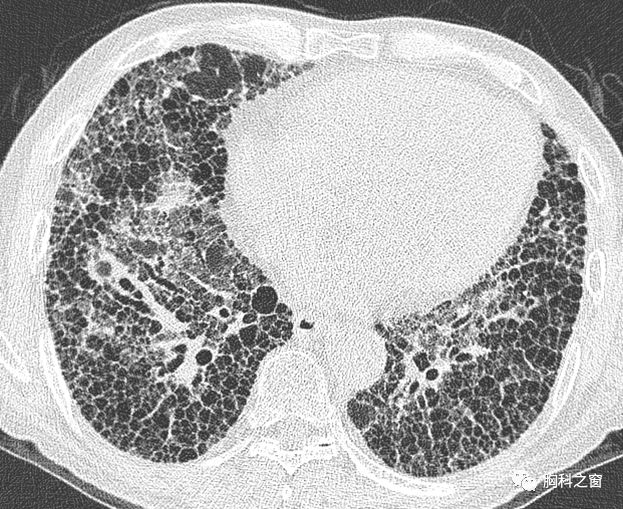 肺间质病变的hrct征象小叶内间质肺间质解剖胸膜下间质支气管血管束
