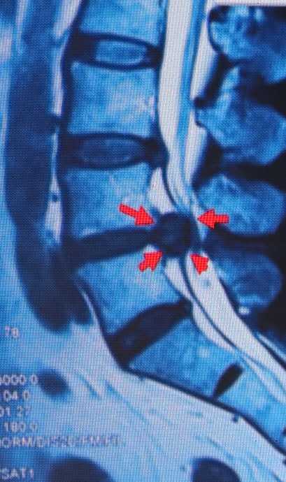 腰椎間盤突出症的分型 未分類 第3張