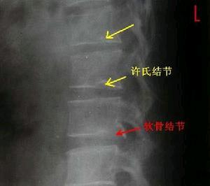 腰椎間盤突出症的分型 未分類 第5張