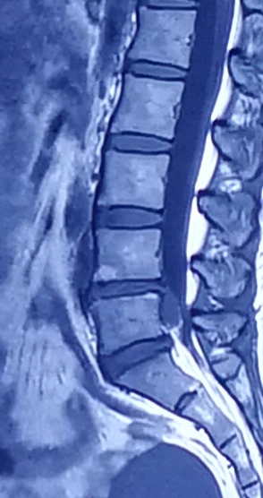 腰椎間盤突出症的分型 未分類 第4張