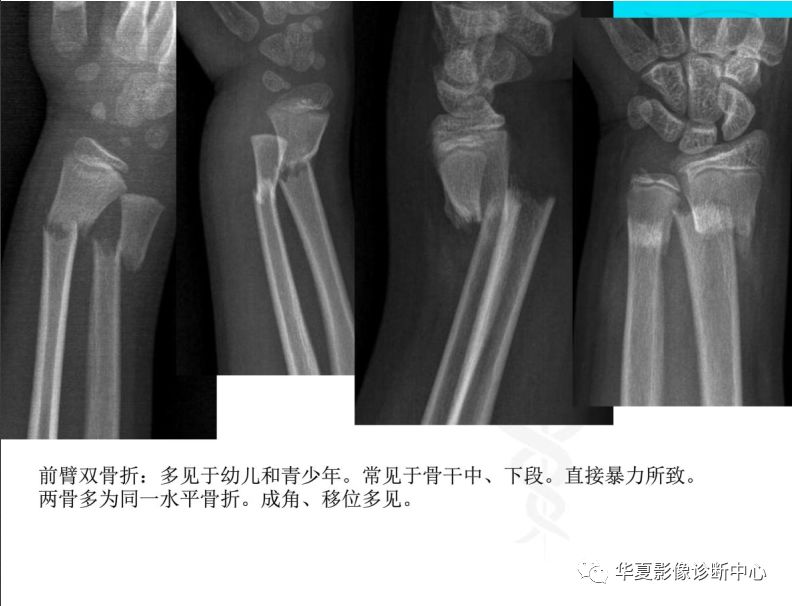 常見部位骨折的x線表現