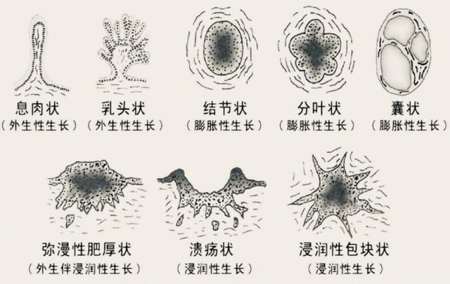 分叶状乳腺结节图片