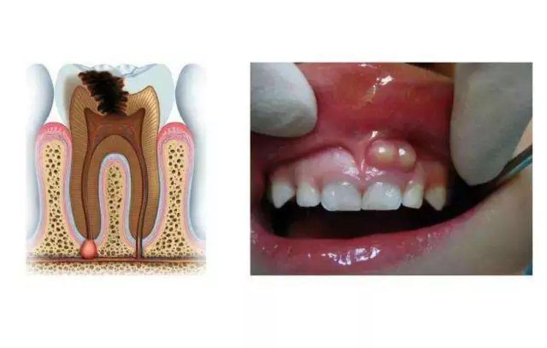 牙齦膿包丨這可不是你想挑破就能挑破的