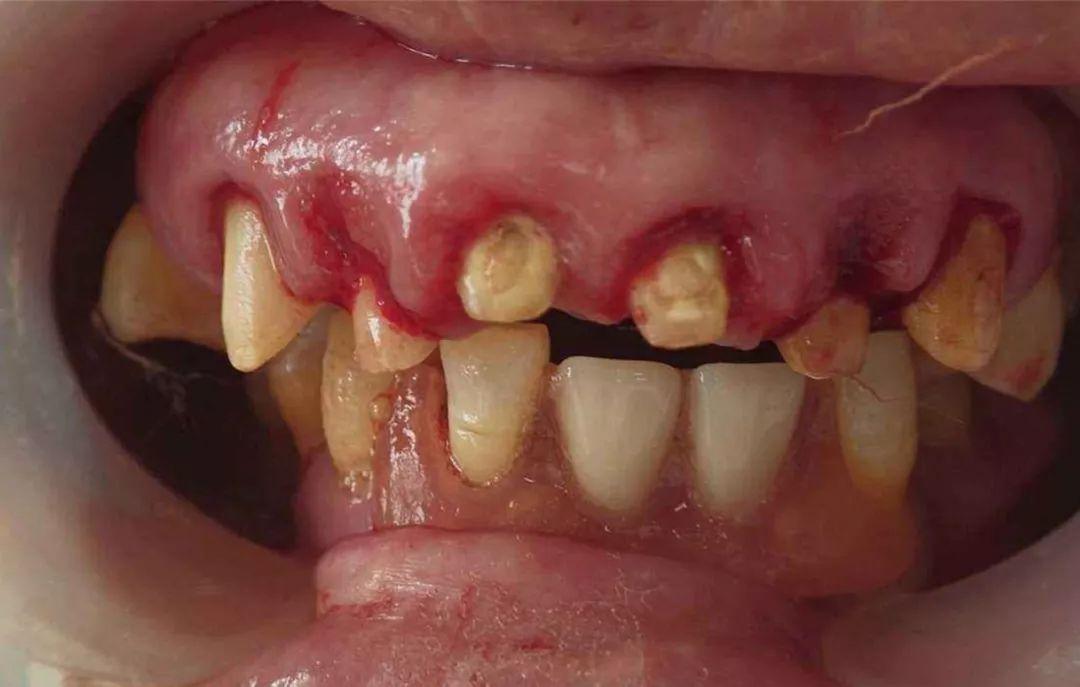 牙龈肿胀隆起有脓图片图片