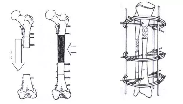 骨搬移手术原理图图片