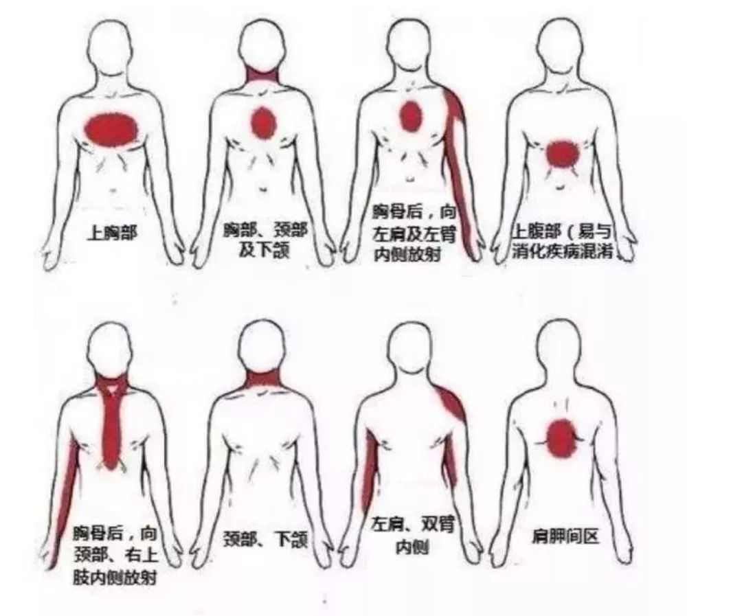 心梗位置判断 图图片