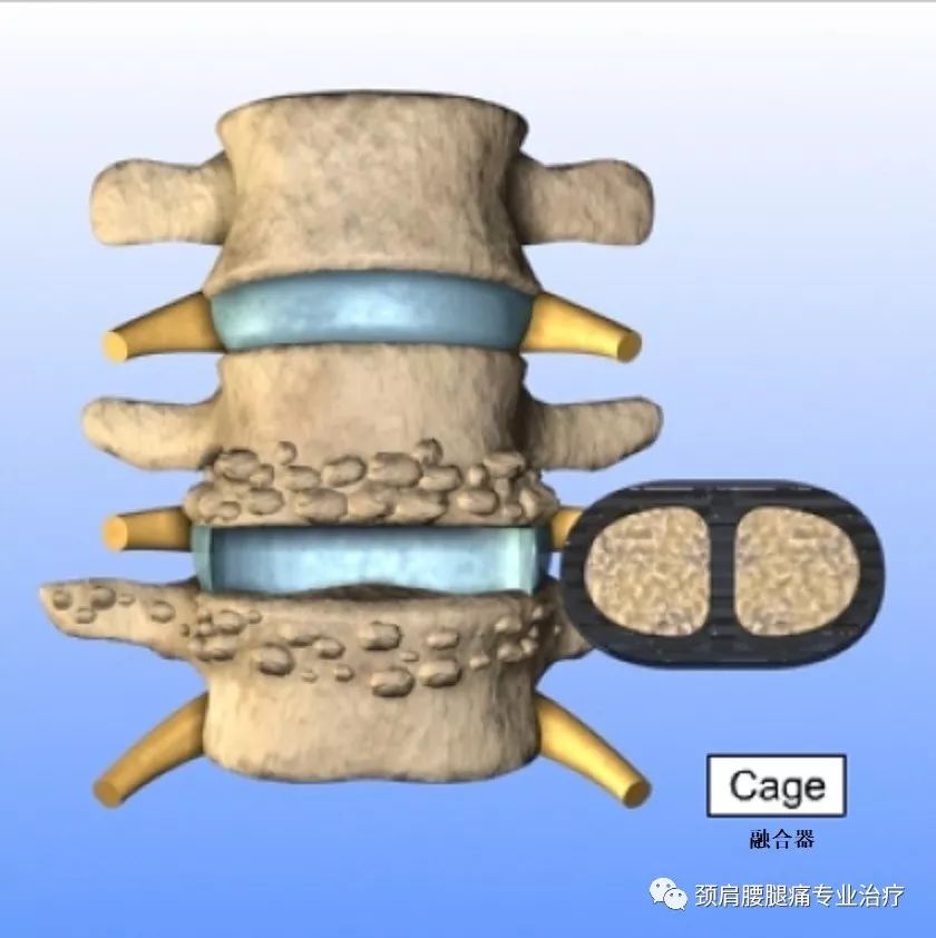 中英文字幕前路腰椎融合术anteriorlumbarinterbodyfusion