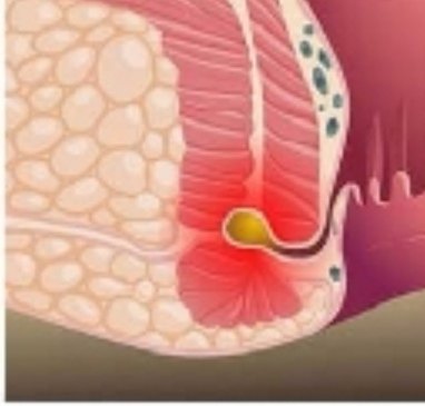 马蹄形肛周脓肿示意图图片