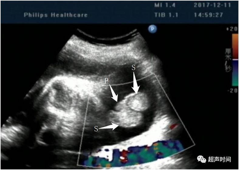 超声典型病例:胎儿尿道下裂