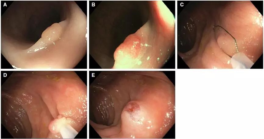 青医 61 新技术丨结肠息肉肠镜下冷切除术