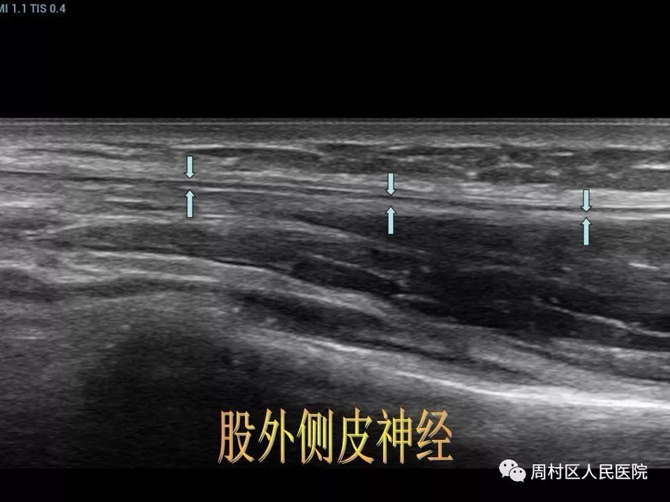 腓总神经超声图图片