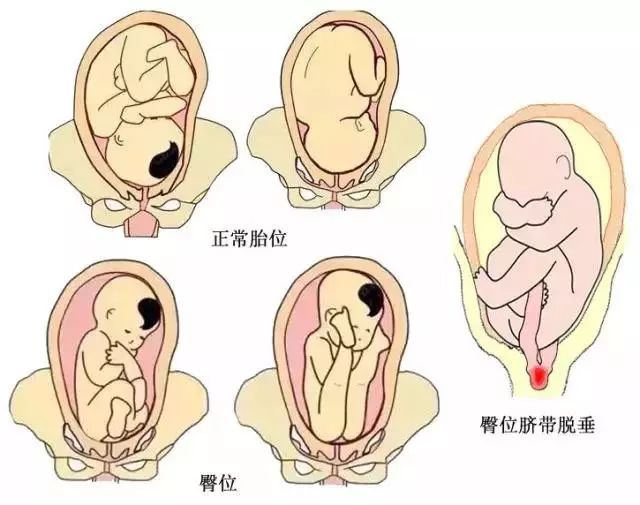 臀位剖宫产的步骤图片图片