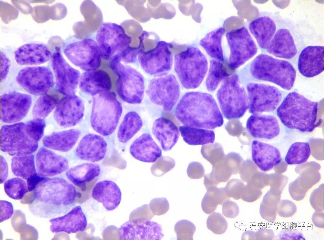 骨髓穿刺塗片細胞學檢查示