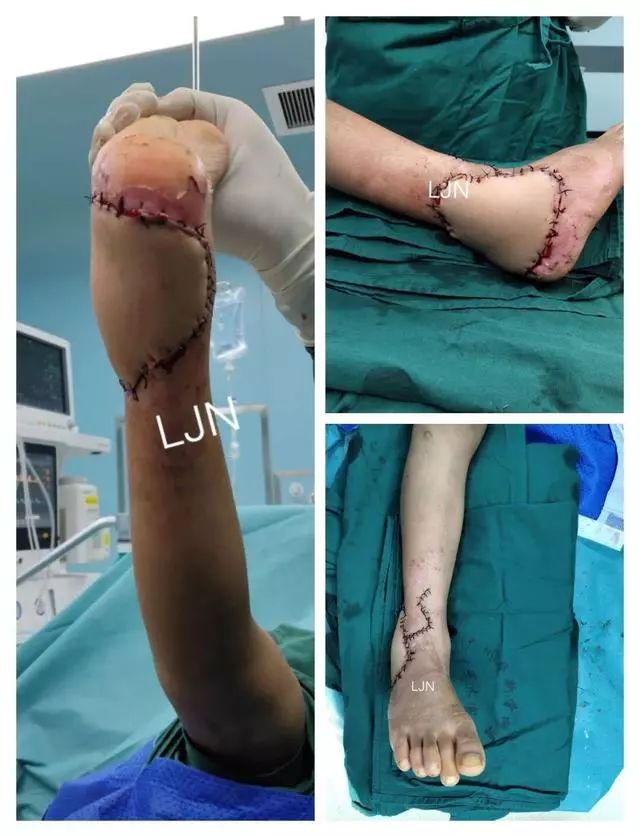 右足踝开放性损伤清创术后病例分享
