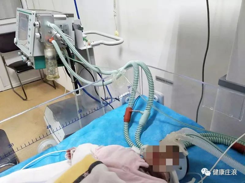 【技术突破】庄浪县中医院儿科成功完成首例气管插管应用肺表面活性