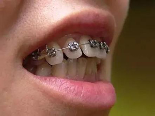 牙齿上下咬颌不齐应该如何修复?