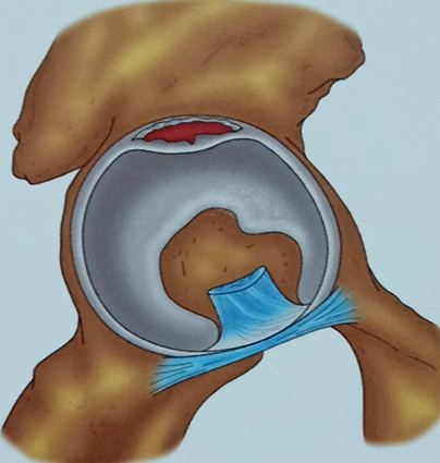 髋关节盂唇解剖图图片