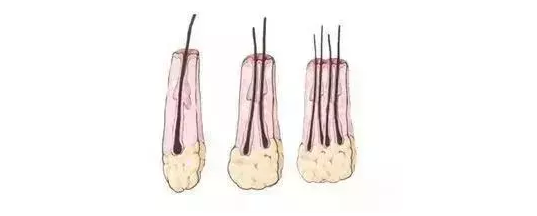 植发手术也叫作毛囊移植,是将后枕部健康