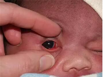 宝宝黄疸图片 眼角图片