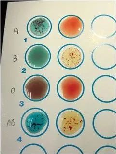 血型鉴定凝集反应图片图片
