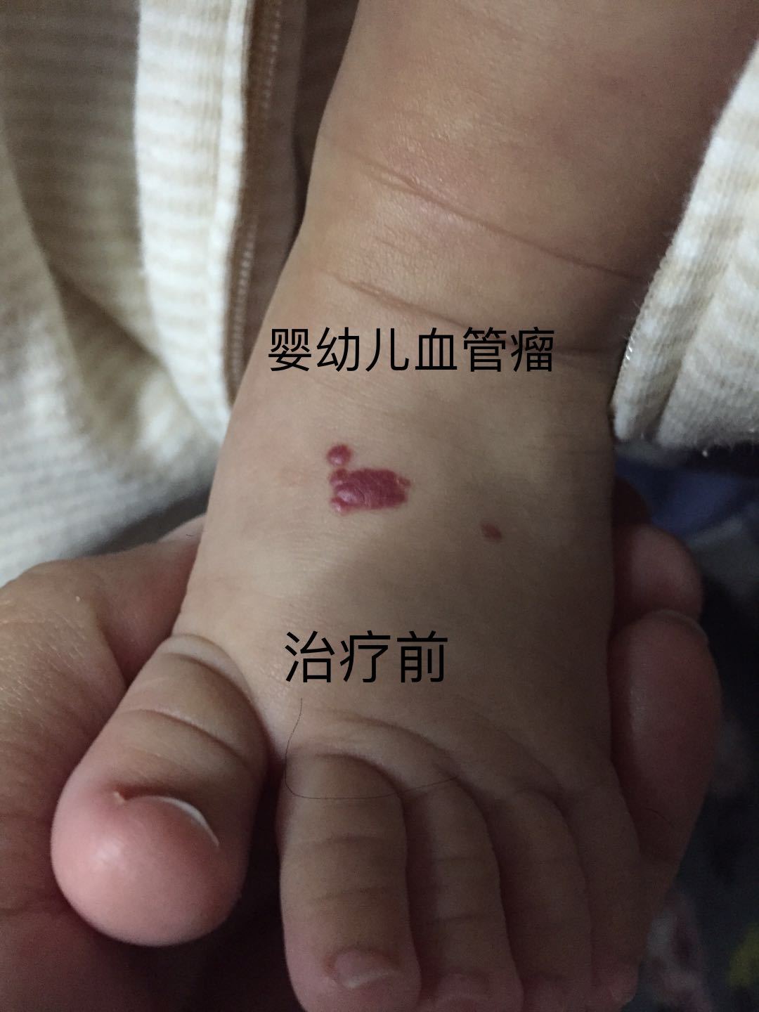 嬰幼兒血管瘤及化膿性肉芽腫治療策略 (原創)