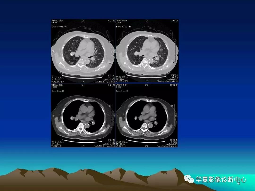 肺错构瘤的影像病例欣赏