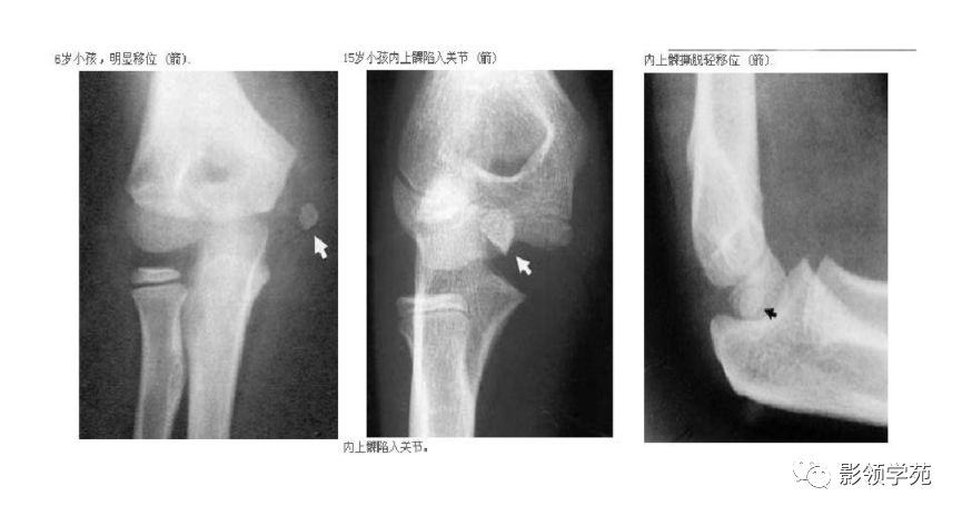 儿童肘关节骨折x线诊断