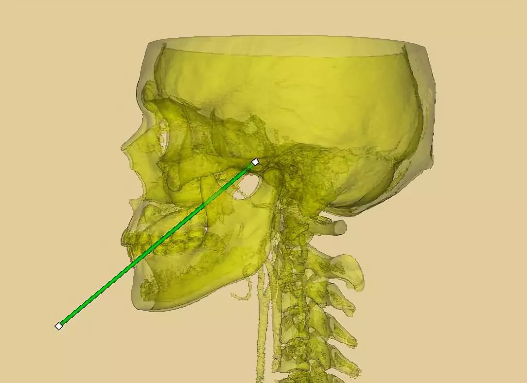 3d打印在三叉神經痛穿刺治療中的應用