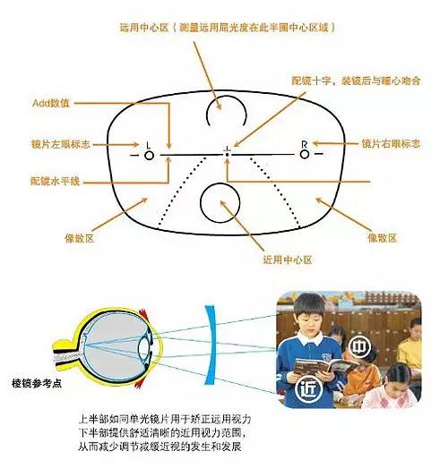 2,青少年漸進多焦點