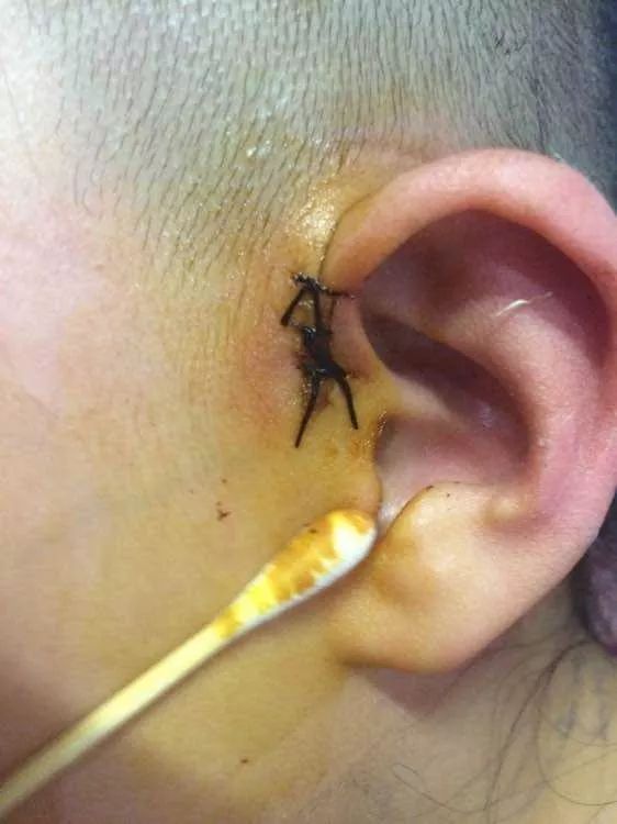 耳仓手术过程图片