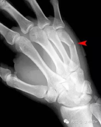 拳擊手骨折boxers fracture▼舟骨骨折▼正常腕關節▼smith骨折▼