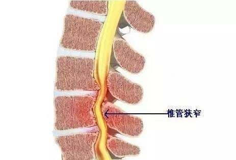 10年腰椎間盤膨出伴椎管狹窄患者康復歷程